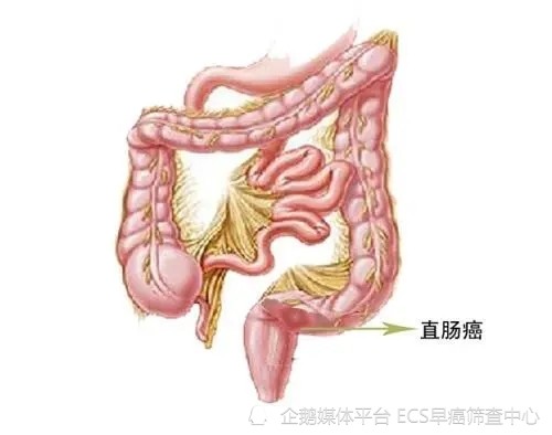 结直肠癌会家族遗传吗？家族遗传癌症基因检测可以防住吗？