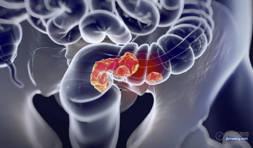 《细胞》重磅：迄今最强肠癌基因变异现身，将刷新对促癌基因的认知！