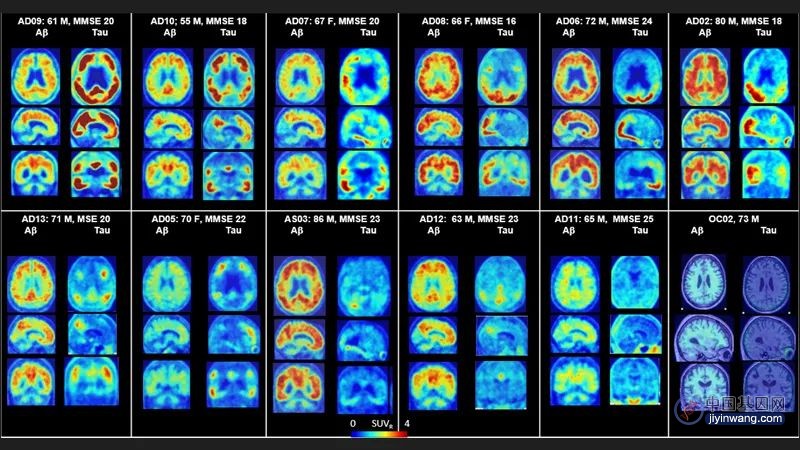 基因组学和分子影像引导的亚型分型细化了阿尔茨海默病的特征