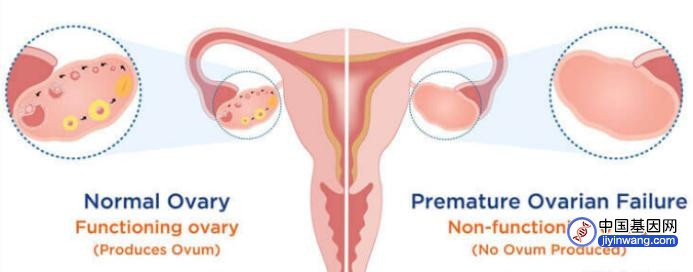 卵巢早衰为什么要做基因检测？卵巢早衰的病因是什么？